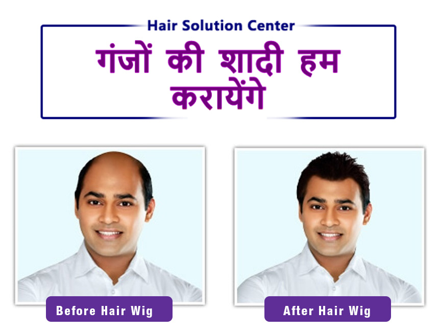Home - Best hair transplant and wig services in patna